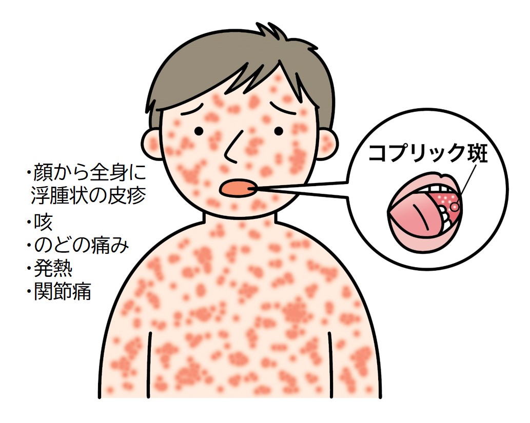 はしかの発疹